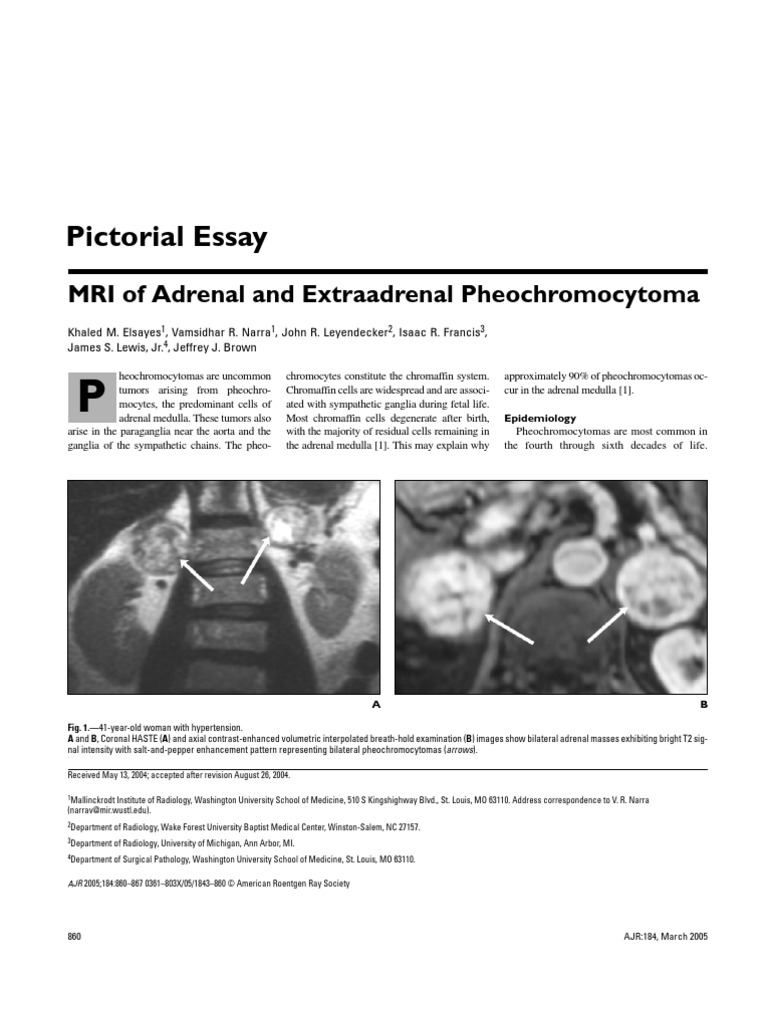 jurnal pheochromocytoma